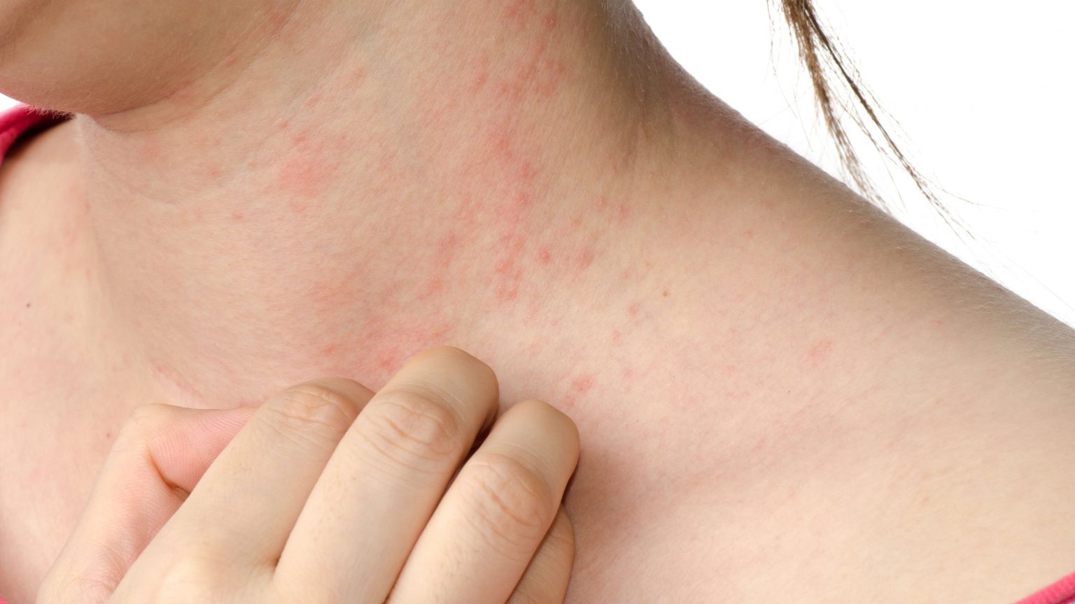 What Are The Signs Of A Severe Allergic Reaction? iCare