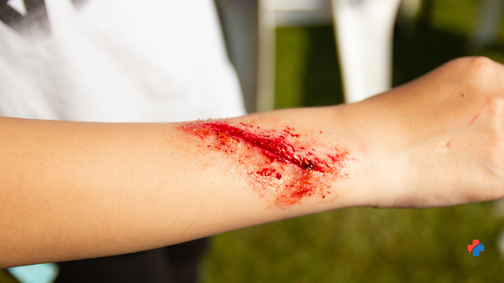 Forearm with a fresh cut and abrasion showing bleeding—example of a wound that may need stitches